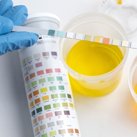 Urinalysis (UDS) Meerut