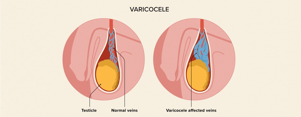 Varicocele Microsurgery Meerut