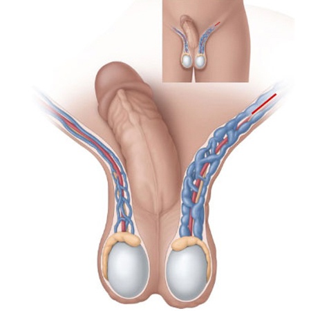 Varicocele Symptoms