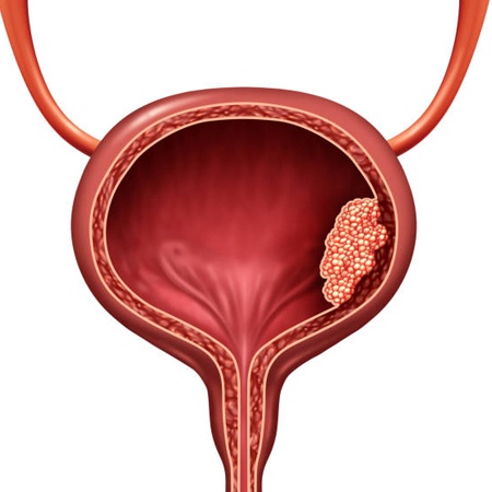 Bladder Cancer Treatment & Surgery Meerut