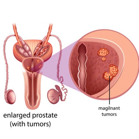 Prostate Cancer Treatment & Surgery Meerut