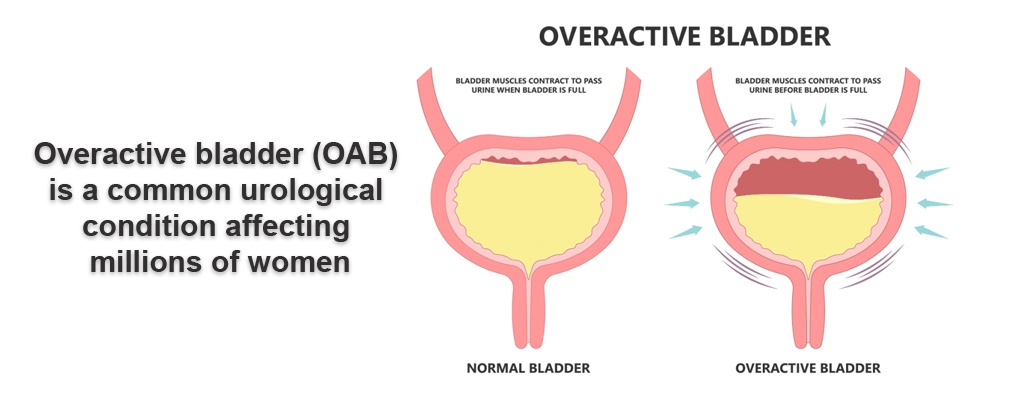 Over Active Bladder Treatment Meerut
