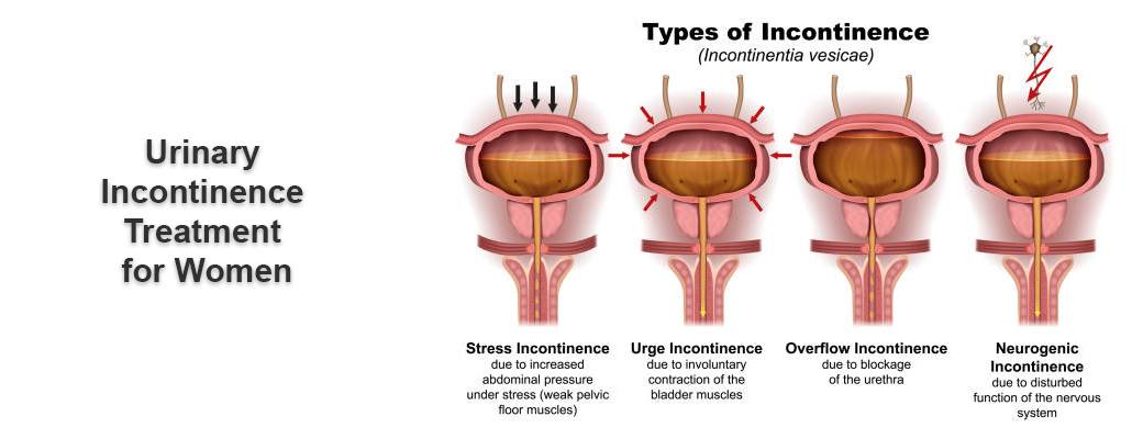 Urinary Incontinence Treatment & Surgery Meerut