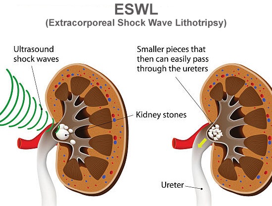 Best ESWL Surgery in Meerut