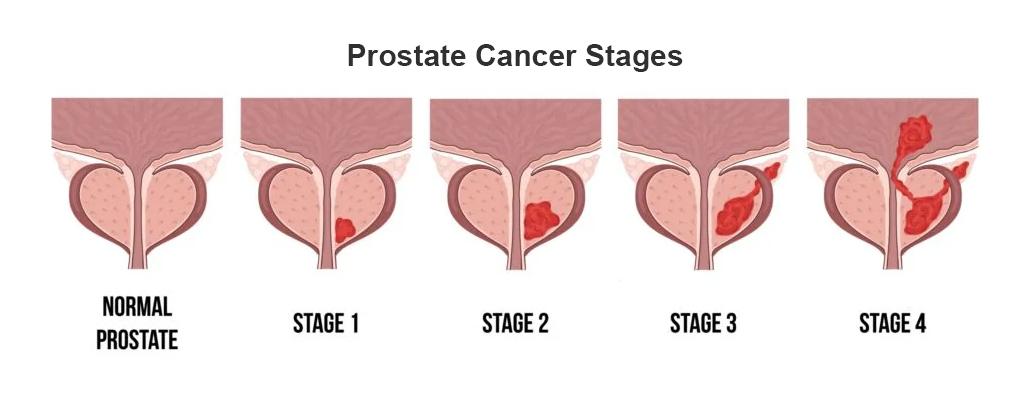 Prostate Cancer Stages