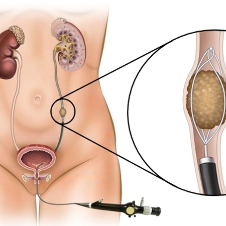 Urologist for Laparoscopic ureterolithotomy Surgery Meerut